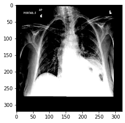 Multi-Label Chest X-Ray Diagnosis (DenseNet-121)